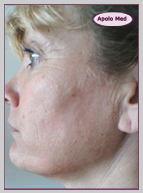 Remodelage visage Bordeaux Radiofréquence bipolaire Bordeaux