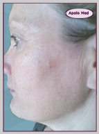 Anti-âge Bordeaux Radiofréquence bipolaire Bordeaux