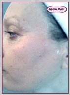 Rajeunissement Bordeaux Radiofréquence Bordeaux