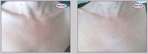 Peau d'orange Bordeaux Radiofréquence bipolaire Bordeaux